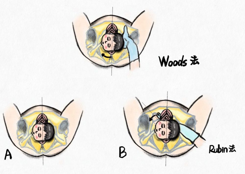 遭遇肩难产,这 6 种方法保你顺利过关_腾讯新闻