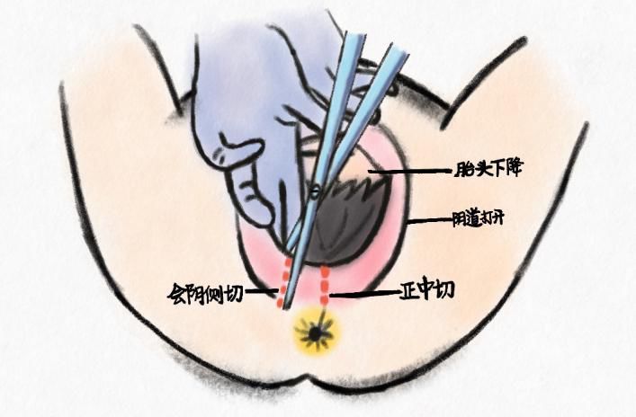 肩难产处理图片