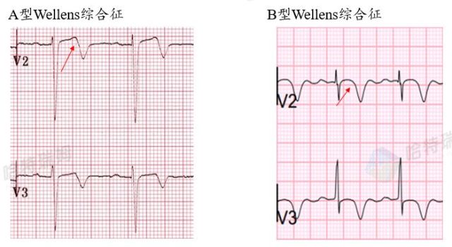 wellens綜合徵的t波改變