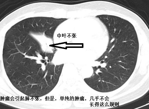 肺不张ct读片太难?看完这篇文章轻松入门!