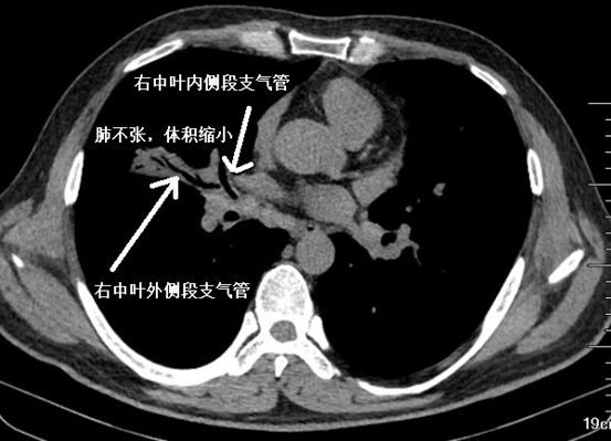 肺不张ct读片太难?看完这篇文章轻松入门!