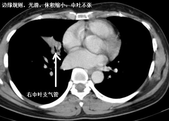 肺不张ct读片太难?看完这篇文章轻松入门!
