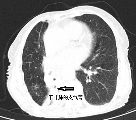 肺不张影像图片