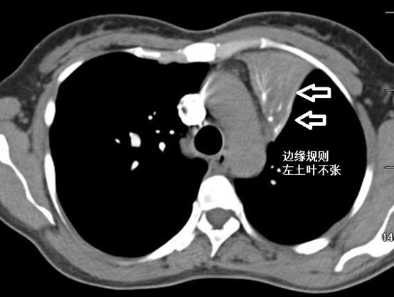 肺不张影像图片