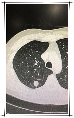 70%磨玻璃肺结节无须着急手术