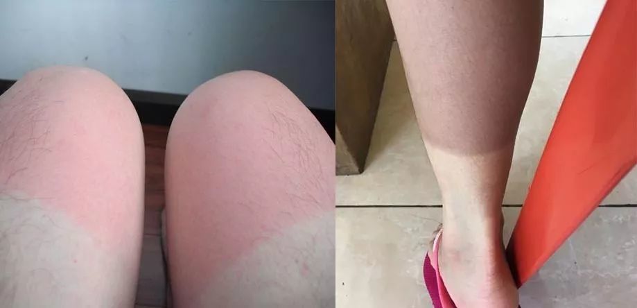 大腿吸脂后鸡皮腿皮肤痒(大腿吸脂后痒痒是怎么回事)