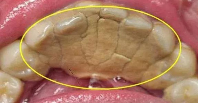 这些软垢不及时刷掉的话,就会慢