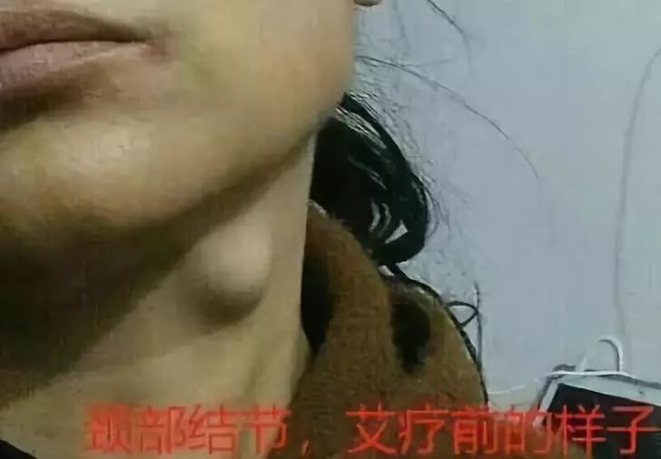 仙草艾资讯-淋巴结,甲状腺结节,乳腺结节等结节,请艾灸!鸡蛋大小甲状