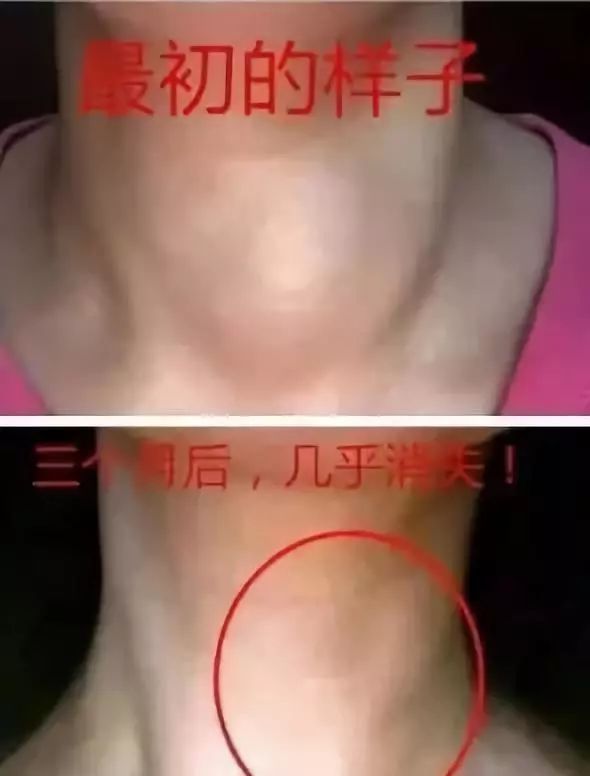 鸡蛋大小甲状腺结节灸3个月消失!-仙草艾资讯-仙草艾官方网站