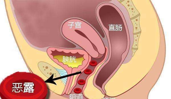 產後惡露要排多久,如何做可以預防產後惡露不盡並且不留月子病?