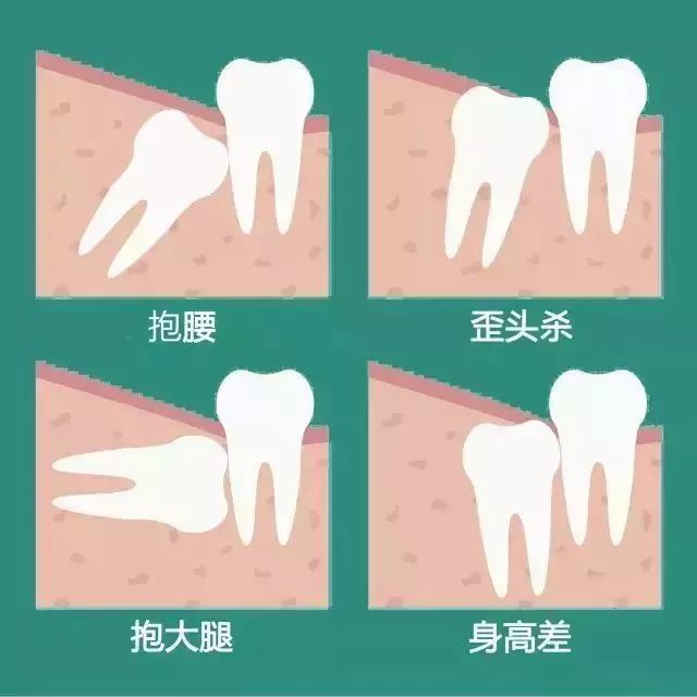 【牙醫必備】這才是拔智齒的最佳方案!_騰訊新聞