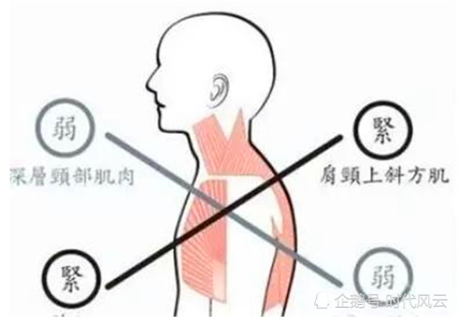 健身可以纠正驼背和头前倾吗 腾讯网