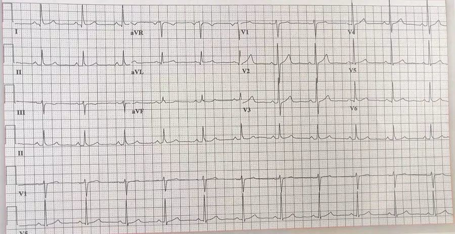 心电图|心电图上的这个小细节，你是不是也忽略了？