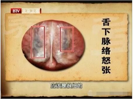 舌下取栓一一重启生命之脉