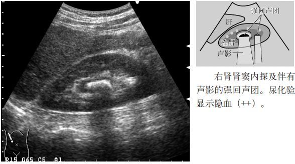 4.腎實質內的高回聲(腎小管酸中毒或海綿腎所致的鈣化).3.