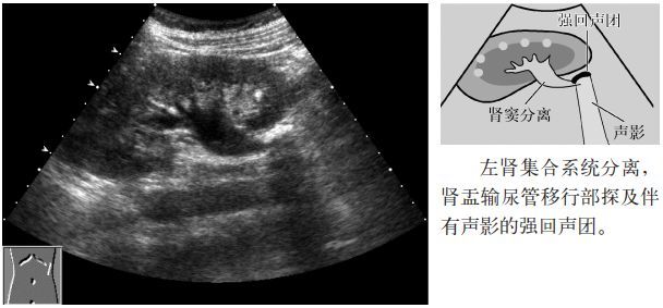 临床必备肾结石输尿管结石超声表现一览