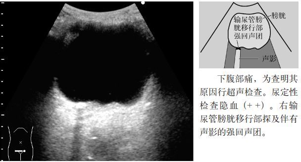 臨床必備腎結石輸尿管結石超聲表現一覽