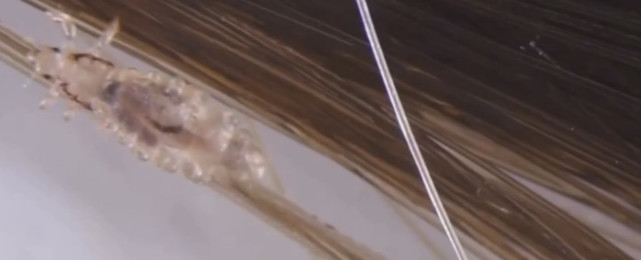 不卫生就会引来虱子 为什么之前的人长虱子 现代人就没有了