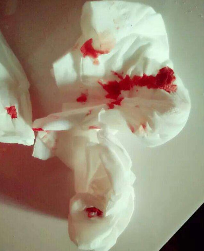 肠癌 总是悄无声息 医生提醒 上厕所出现3 迹象 早自检 腾讯网