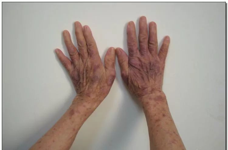 全世界其实对红斑狼疮都是保守治疗,即使最新的sle治疗法也不一定适用