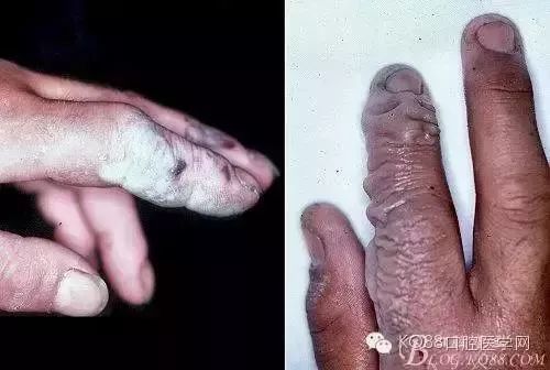 恐怖氢氟酸处理不当他的手指差点废了