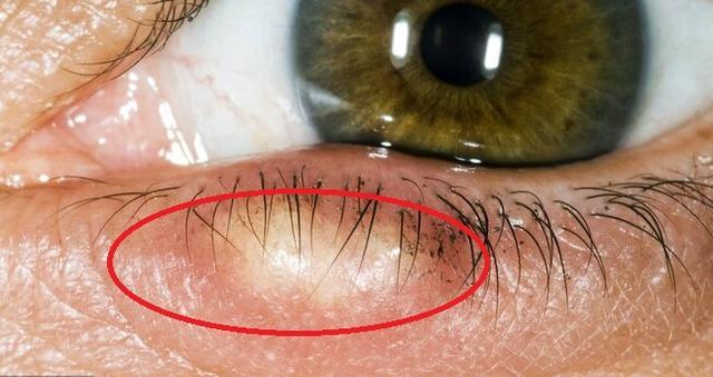 身体出问题 眼睛会发信号 医生提醒 这几种眼部症状早查 别拖