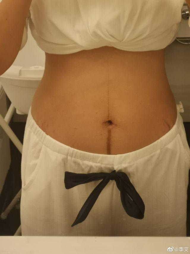 孕妈肚子上有条 妊娠线 有的孕妈妈还没长 你可知这些小秘密