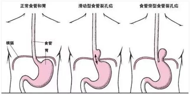 烧心是什么原理_烧心吃什么药(2)