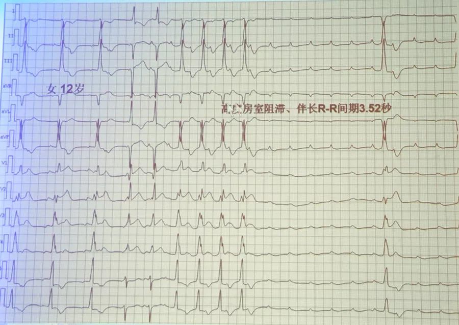 提示嚴重低鉀血癥心電圖表現[qt(u)顯著延長,出現快速性心律失常,並