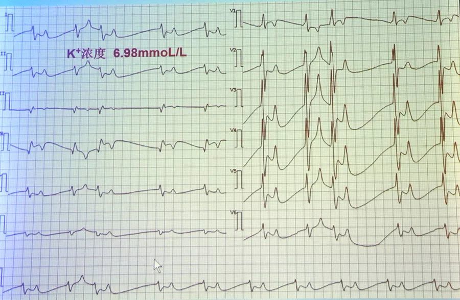 电交替的心电图表现图片