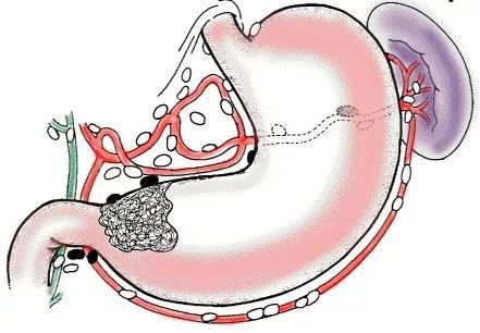 肠上皮化生这6点是治疗的关键