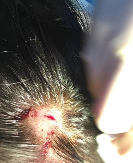 武大校花拍戏头部被砸 伤口血流不止