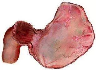 萎缩性胃炎伴肠化生,严重吗?