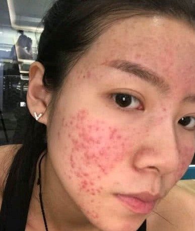 女生"满脸痘痘"几乎毁容,这3种水果使劲儿吃,应该能"自救"