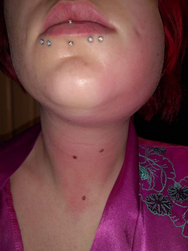 英国女子拔智齿伤口不慎感染,人突然休克,几乎要了她的命