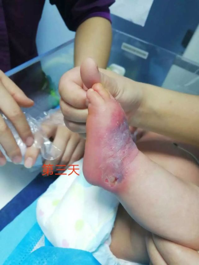 新生儿输液渗漏(3)