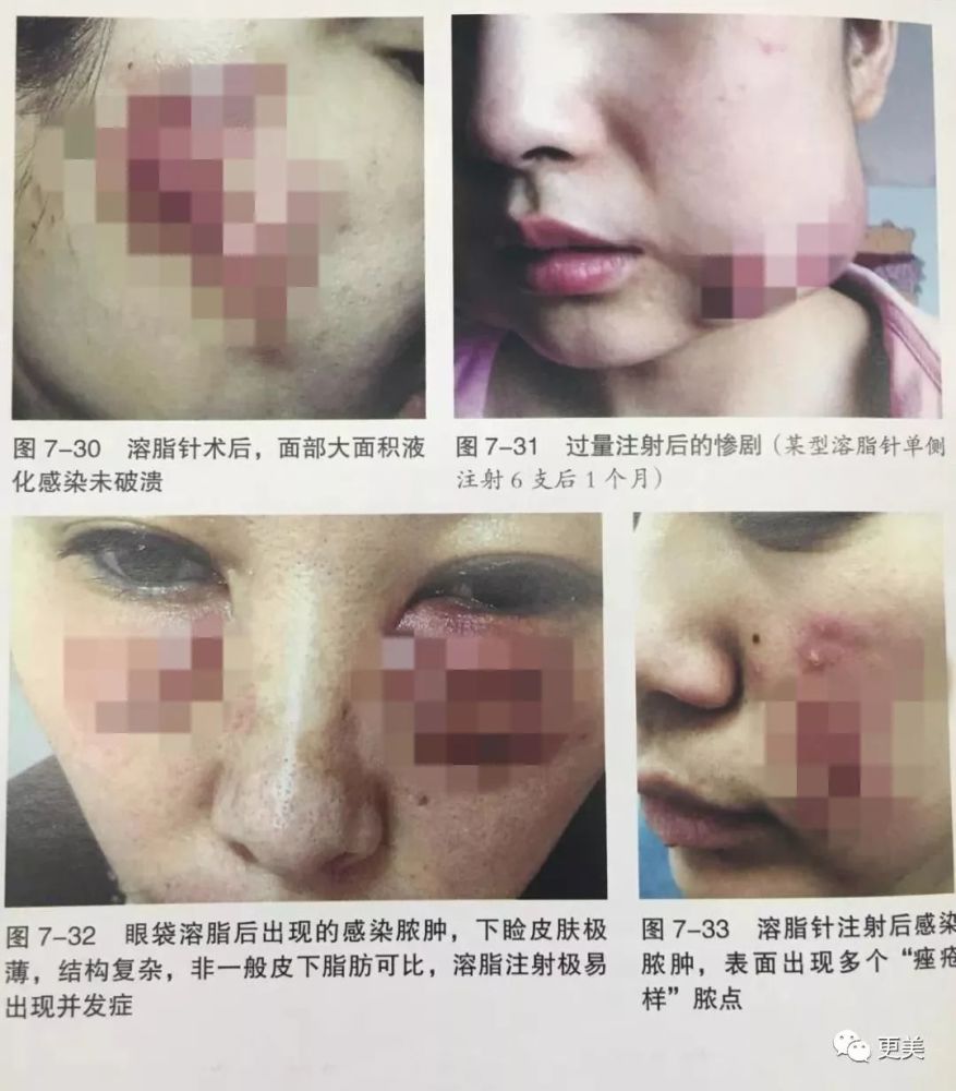 注射 脂肪 溶解