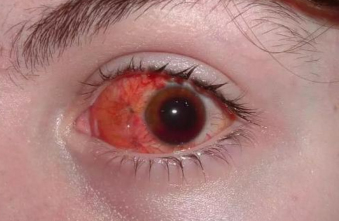 一般人偶尔熬夜后,眼睛会有很明显的症状,那就是眼睛里面有血丝,待