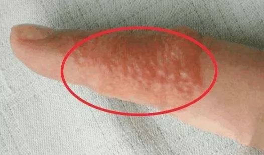 好多人都会长的这种小水疱,是什么情况?_腾讯新闻