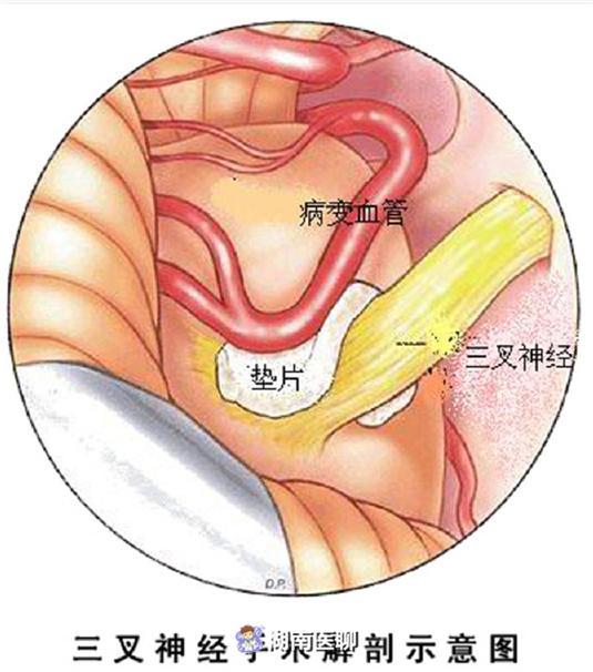 面部突發疼痛痛不欲生手術解除三叉神經痛醫生在耳後開小口