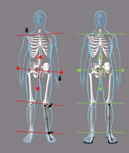 都直接或间接与我们的骨盆有一定的关系,比如我们常见的高低肩,长短腿