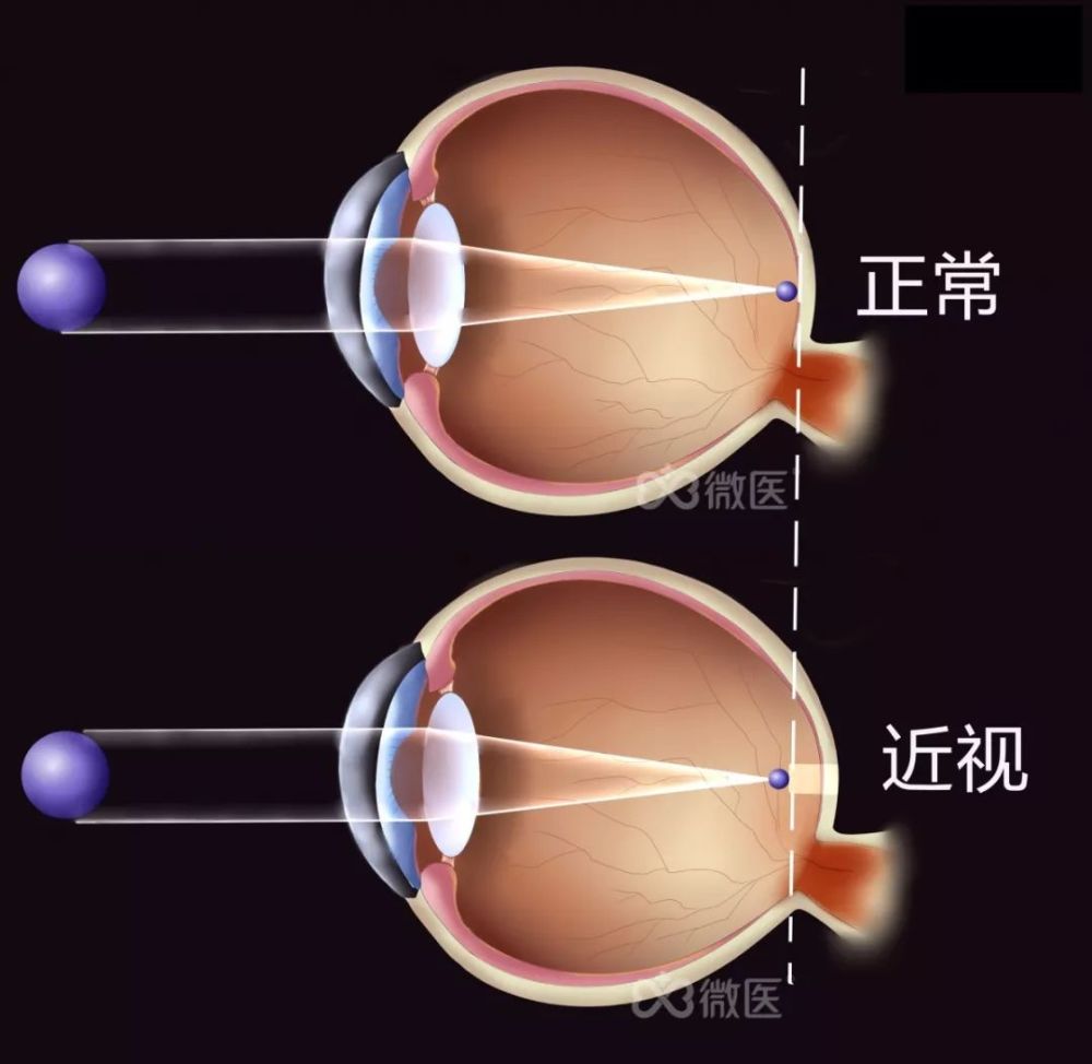 近视手术大揭秘 近视手术靠谱吗 为什么那么多医生选择戴眼镜