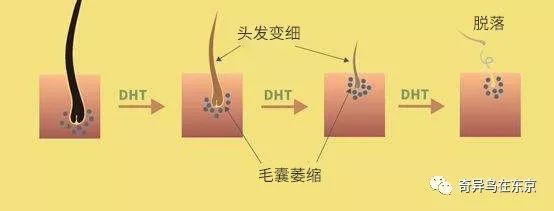 雄脱 最后的救星 植发不能拯救的脱发 它可以 丨日本整容整形