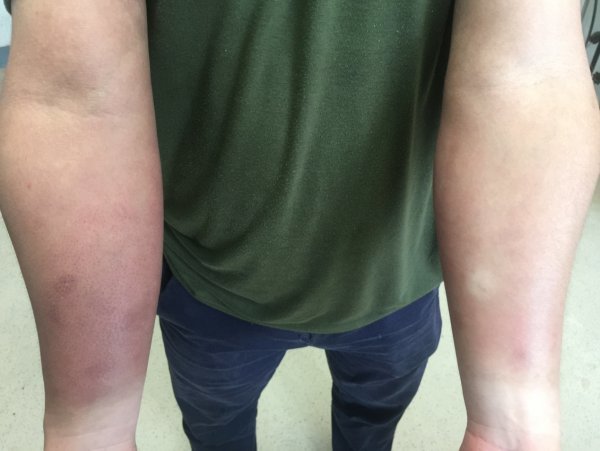 娄底一男子收废品手臂刺痛起泡 原来是不经意间接触了它