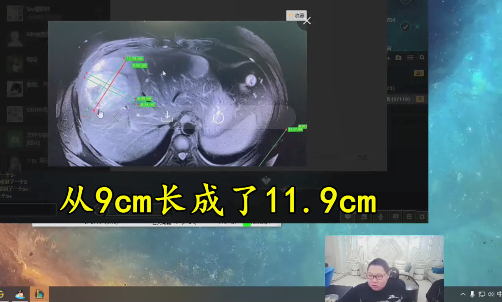 pdd恐将再次停播,肿瘤持续增大,已经11.9厘米,滴酒不沾