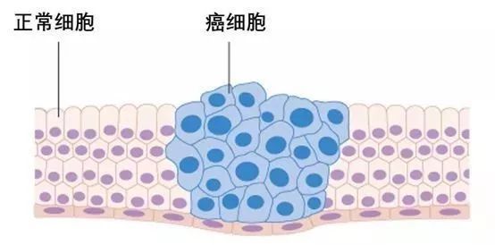 癌症转移,癌细胞最容易转移至哪些部位?