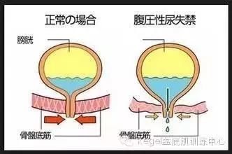 产后盆底肌肉的功能评估及康复治疗 腾讯新闻