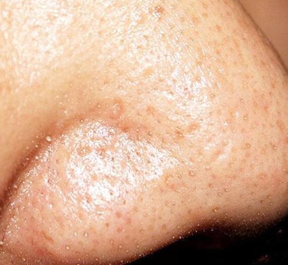 然后变硬氧化变成了黑色的脂化物,这就形成了所谓的黑头了