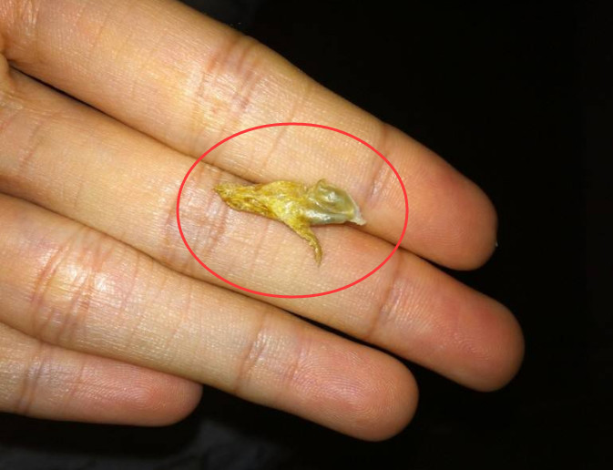 为啥有人耳屎又湿又油 有人却 干巴巴 的 意味着什么