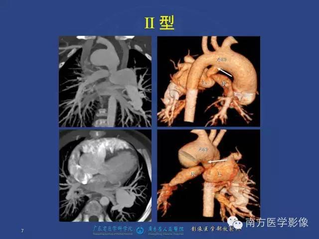 肺動脈閉鎖合併室間隔缺損